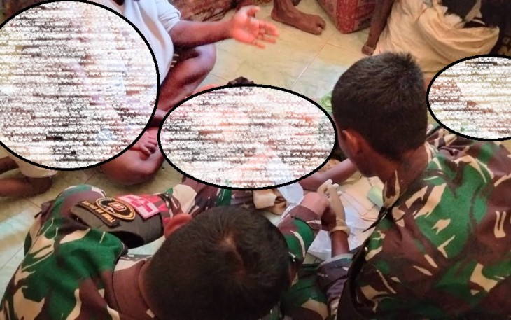  Tim Kesehatan Satgas Pamtas Statis RI-PNG Yonif 111/KB Tangani Korban Luka Bakar Anak Warga Pedalaman Papua Selatan