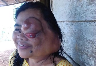 Sunarmi Warga Melati Harjo Butuh Perhatian dan Uluran Tangan Dermawan