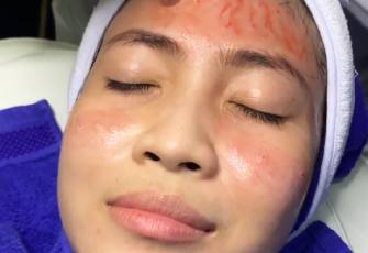 Cara Ampuh Mengatasi Bopeng Bekas Jerawat