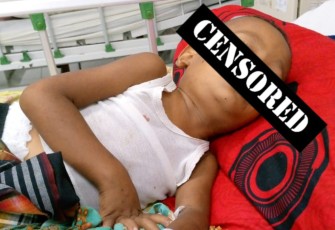 Al Karim Bocah 4 Tahun di Aceh Timur Didera Penyakit Bertubi-tubi